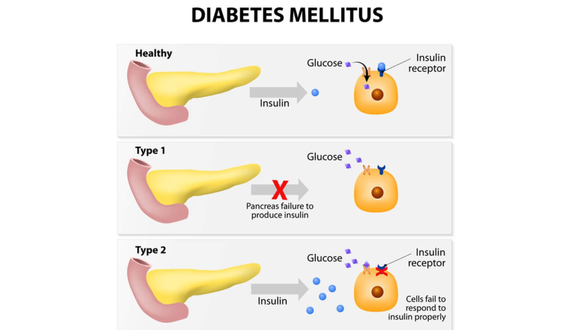 Type 2 diabetes mellitus